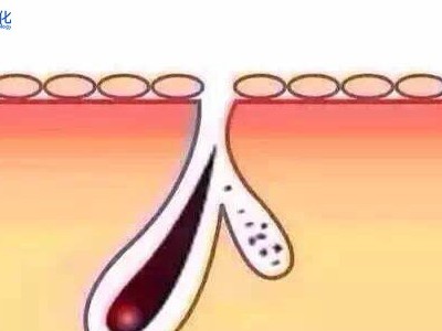 如何有效的防止黑头
