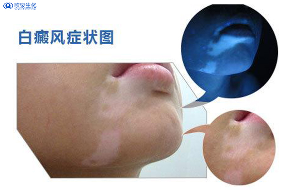 白癜风患者能使用化妆品吗？