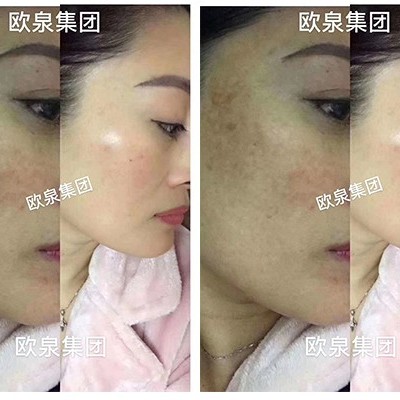 如何正确领悟预防色斑的要素