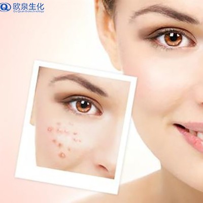 护肤品厂家：痘痘长期存在的原因